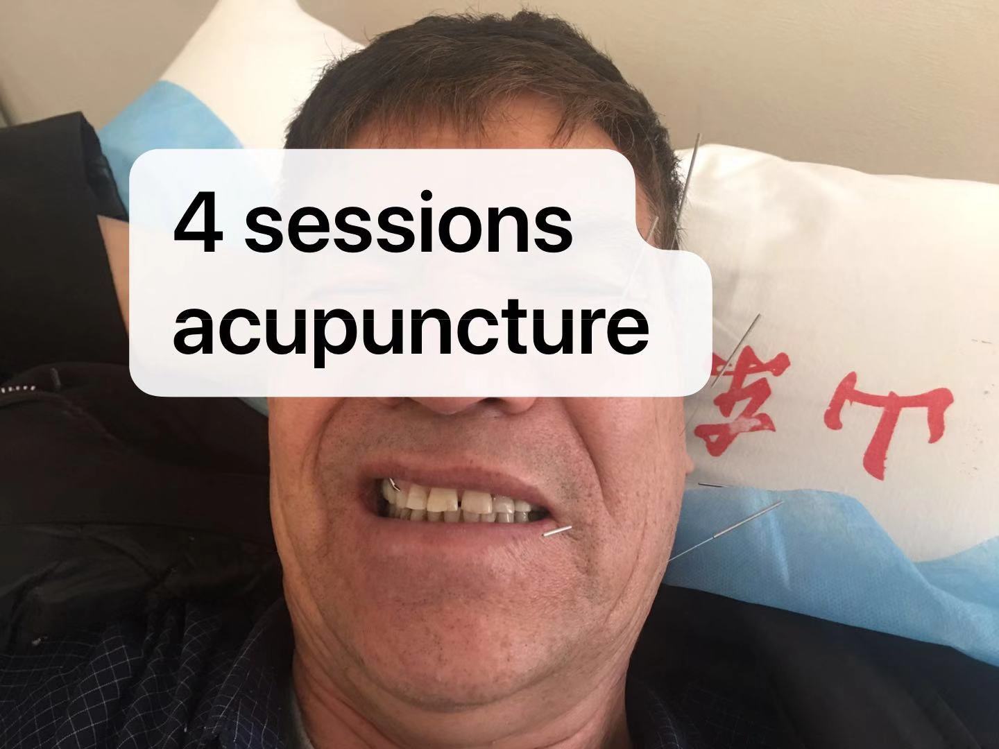 Acupuncture For Bell S Palsy Auckland Acupuncture And Chinese