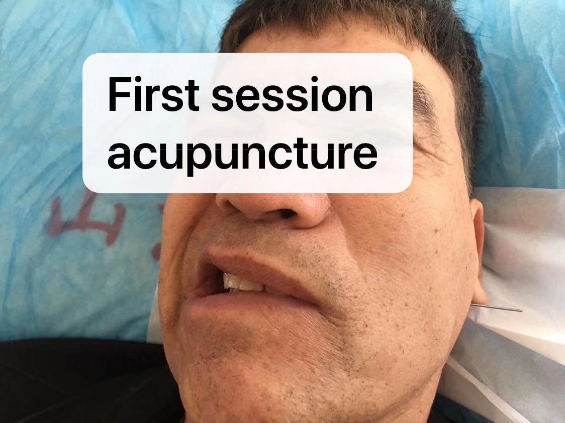 acupuncture for Bell's palsy Auckland Acupuncture and Chinese