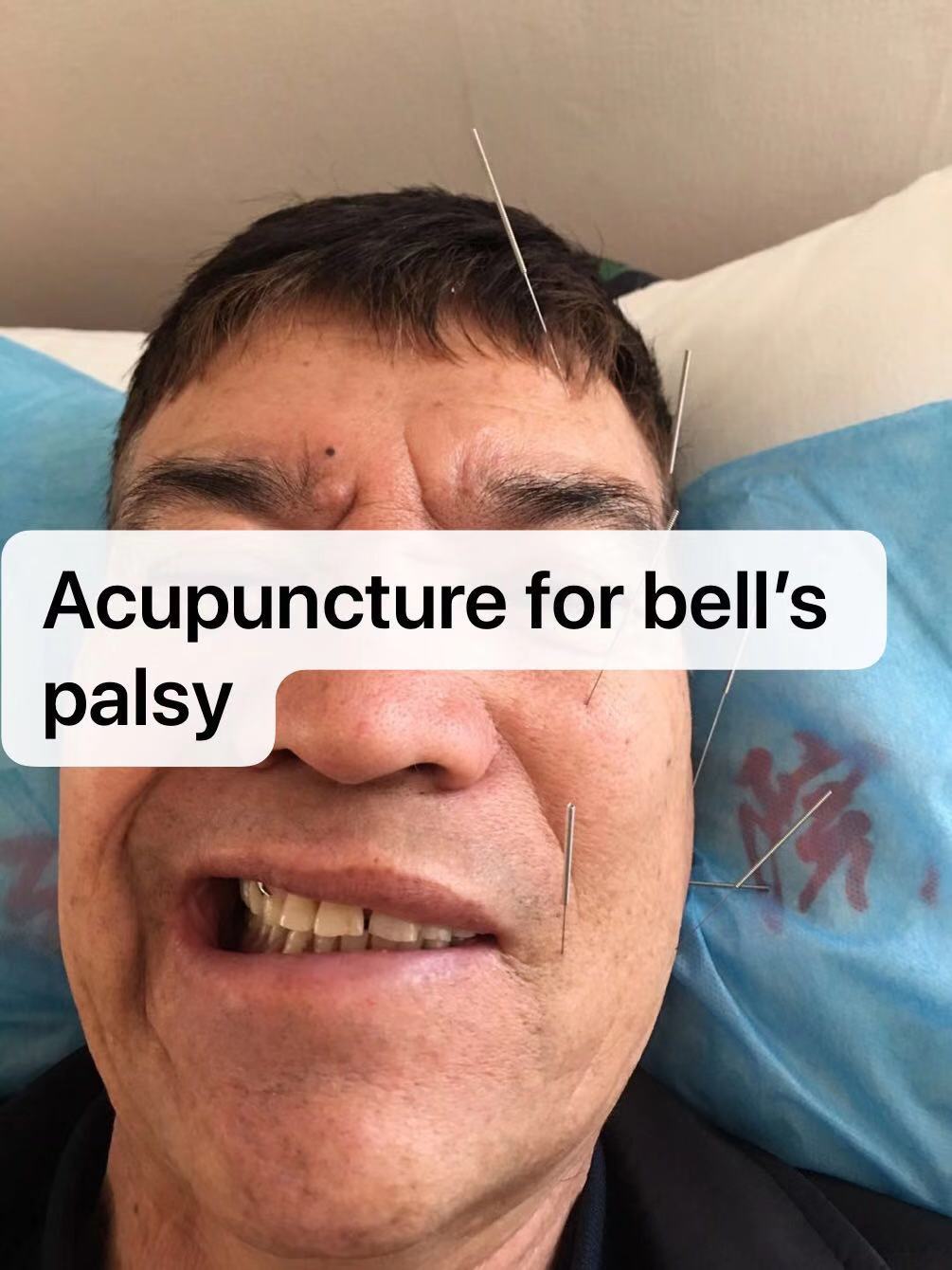 acupuncture for Bell's palsy Auckland Acupuncture and Chinese