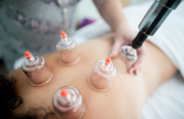 pain management cupping auckland