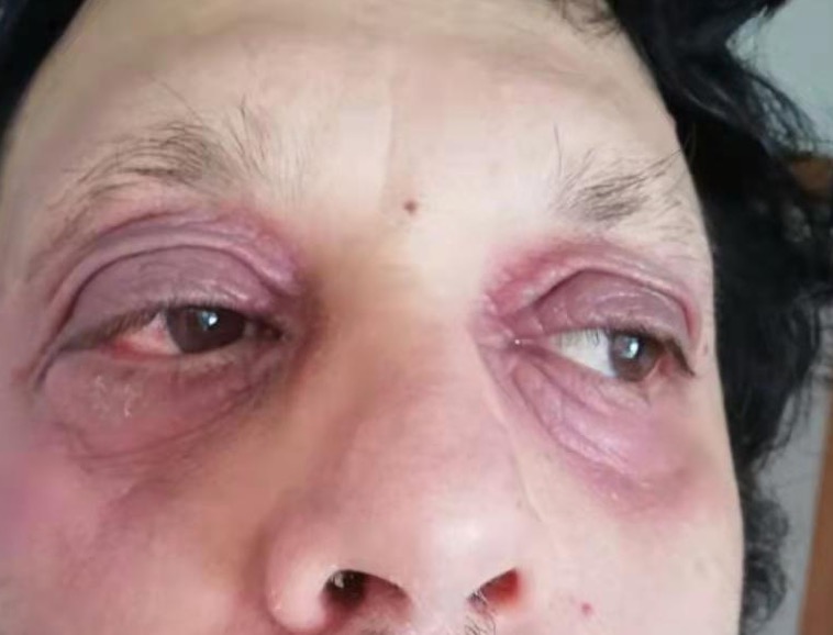 血管性水肿 奥克兰 中医 针灸 皮肤病
