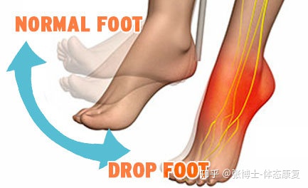 feet drop down, dorsiflexion of the left ankle is weakness, and toe lifting is weakness too, the feeling is dull in the instep