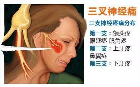 acupuncture, auckland, pain worse while eating, speaking and washing.trigeminal neurogia, bad face pain