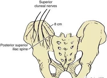 pseudosciatica.gluteal epithelial nerve entrapment, auckland, newzealand, lower back pain, severe pain from sitting to standing