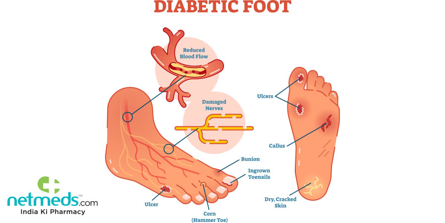 itch and tingling foot, diabetes foot, numbness foot, auckland, newzealand, acupuncture, chinese medicine