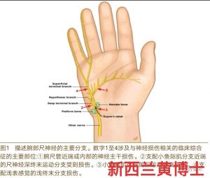 手麻木，无力，疼痛，手麻，手腕痛，前臂痛，奥克兰，新西兰，微针刀 手麻木，无力，疼痛，手麻，手腕痛，前臂痛，奥克兰，新西兰，微针刀