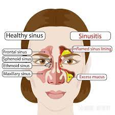 acute sinusitis, chronic sinusitis, block nose, facial pain, running, auckland, acupuncture