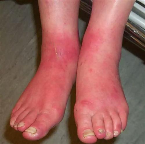 hands and feet cold ，hot and tingling in feet ，red skin in hot