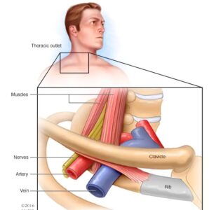 Thoracic outlet syndrome