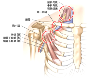 胸廓出口综合征，手麻，上肢痛，肩痛，手冷，手无力，奥克兰中医针灸