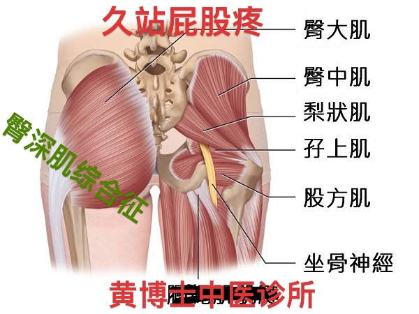 久站屁股疼，久站腿麻木，臀部深肌综合征，奥克兰，中医，针灸，正骨，诊所