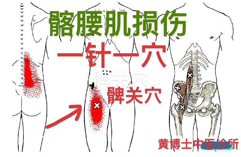 髂腰肌损伤 ，剧烈腰痛 ， 弯腰不能 ，一针一穴 立竿见影， 奥克兰中医诊所