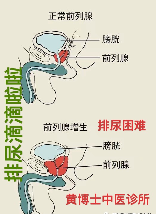 排尿前小腹痛，会阴区疼痛，小腹胀，排尿无力，排尿不尽，滴尿，尿频。奥克兰中医诊所