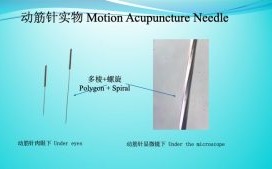 chronic pain syndrome, severe pain case, pain 13 years, injection for 7 years, injection once 3-4 weeks, more painkillers, motion needle acupuncture