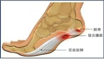 plantar fasciitis