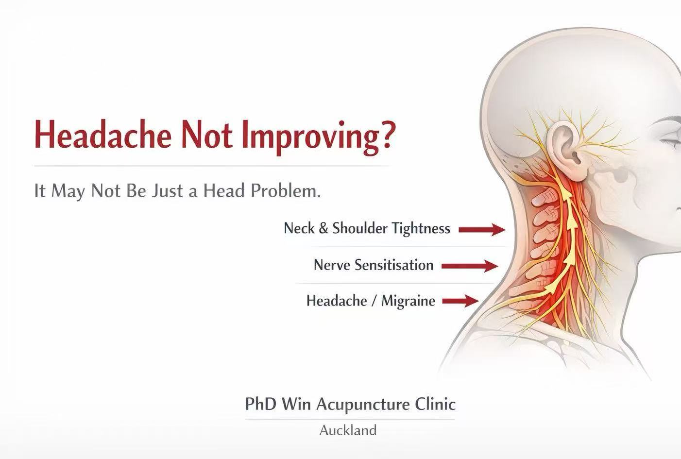 headache acupuncture clinic auckland