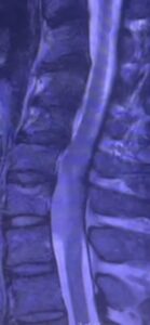 tumor spine Auckland acupuncture